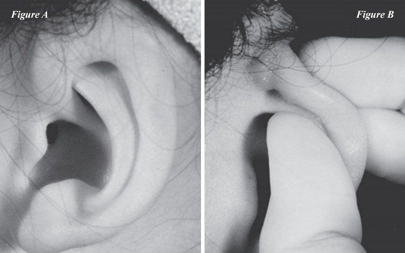 cryptotia before and after