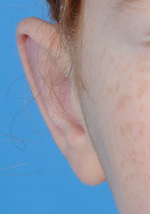 revision otoplasty after