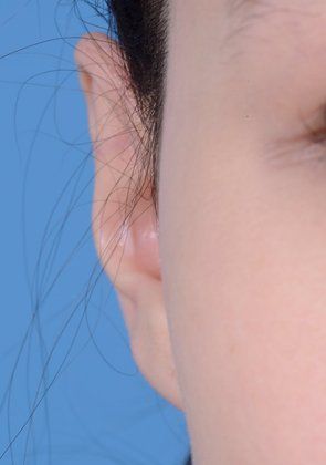 upper ear reduction after
