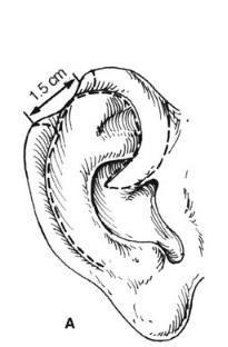 helical1