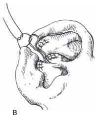 Wedge resection1
