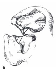 Wedge resection2