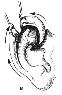 helical2
