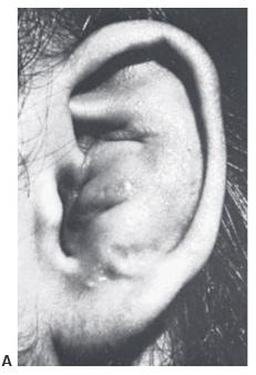 acute othematoma A
