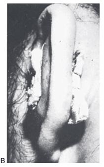 acute othematoma B