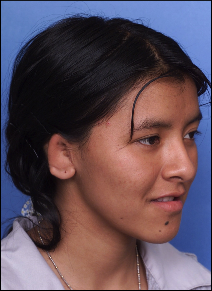 redo ear reconstruction before