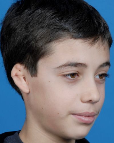 right ear reconstruction before